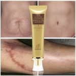 Useful LANBENA Acne Scar Removal Cream buy now with Shop&Shop